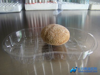 患了膀胱结石怎么办